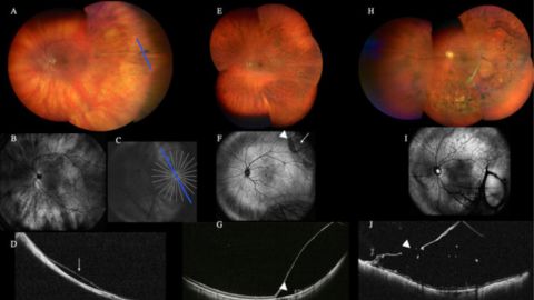 Ultra-widefield with Optical Coherence Tomographic